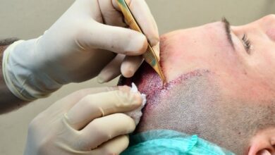 What Is Hair Transplant Surgery- You Need Know