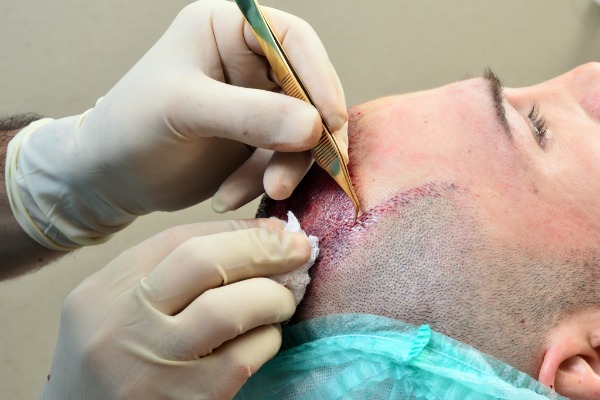 What Is Hair Transplant Surgery- You Need Know